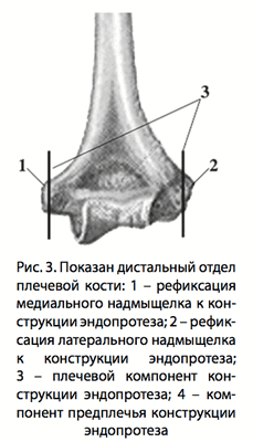 Рис. 3. Показан дистальный отдел плечевой кости