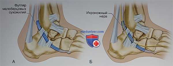 Операция при переломе пяточной кости в объеме расширенного наружного доступа, открытой репозиции и внутренней фиксации