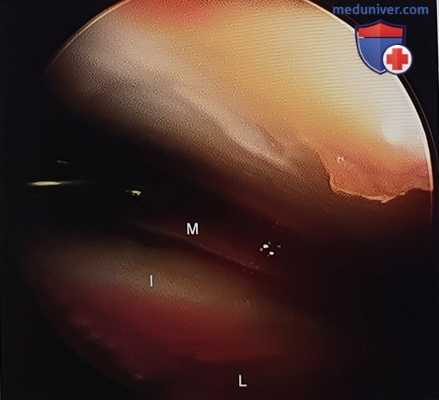 Операция при переломе пяточной кости в объеме расширенного наружного доступа, открытой репозиции и внутренней фиксации