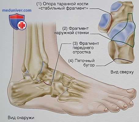 Операция при внутрисуставном переломе пяточной кости