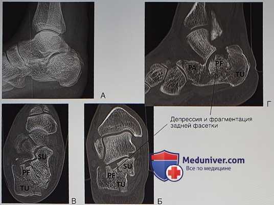 Операция при переломе пяточной кости в объеме расширенного наружного доступа, открытой репозиции и внутренней фиксации