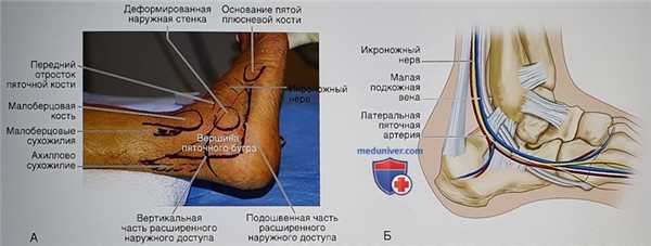 Операция при переломе пяточной кости в объеме расширенного наружного доступа, открытой репозиции и внутренней фиксации