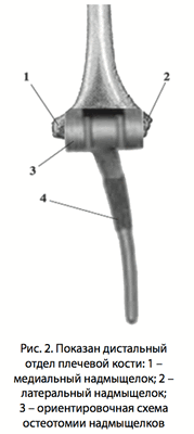 Рис. 2. Показан дистальный отдел плечевой кости