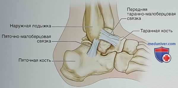 Модифицированная операция Брострома в изолированном виде или в сочетании с внутренним шинированием при латеральной нестабильности голеностопного сустава