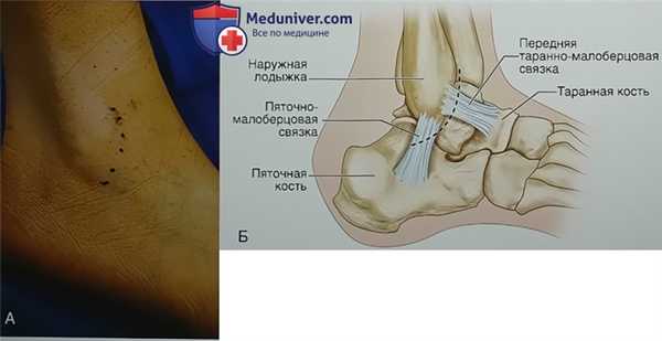 Модифицированная операция Брострома в изолированном виде или в сочетании с внутренним шинированием при латеральной нестабильности голеностопного сустава