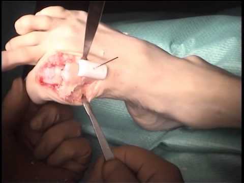 Артродез 1-го плюснефалангового сустава