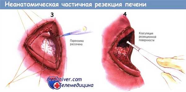 Методика неанатомической частичной резекции печени