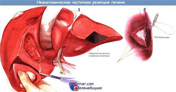 Методика неанатомической частичной резекции печени