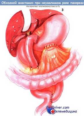 Методика наложения обходного анастомоза при неудалимом раке поджелудочной железы