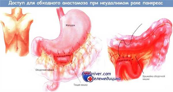 Доступ для обходного анастомоза при неудалимом раке поджелудочной железы