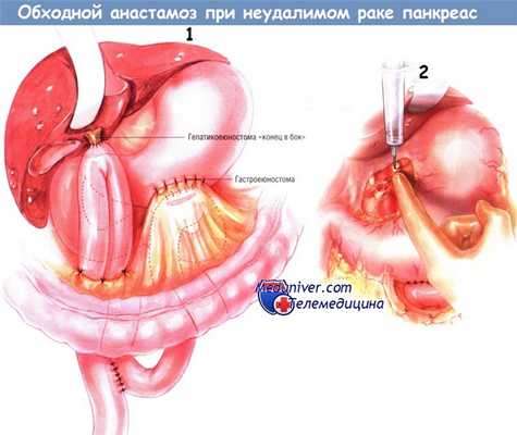 Методика наложения обходного анастомоза при неудалимом раке поджелудочной железы