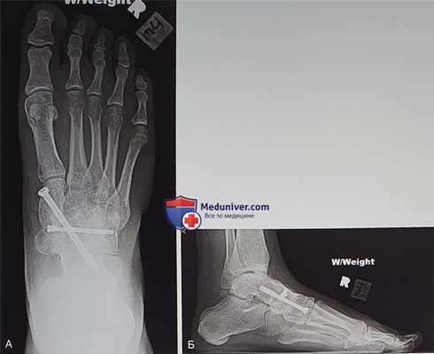 Показания для панладьевидного артродеза при болезни Мюллера-Вайсса