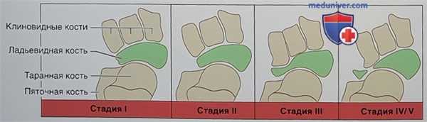 Артродез при болезни Мюллера-Вайсса