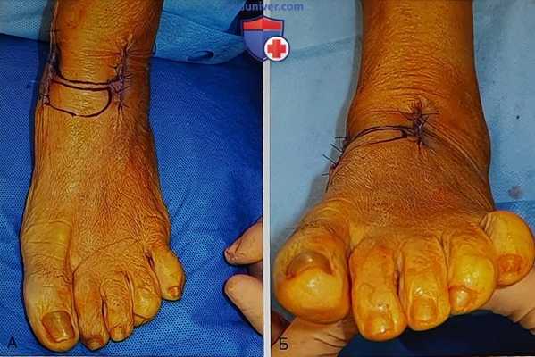 Артродез при болезни Мюллера-Вайсса