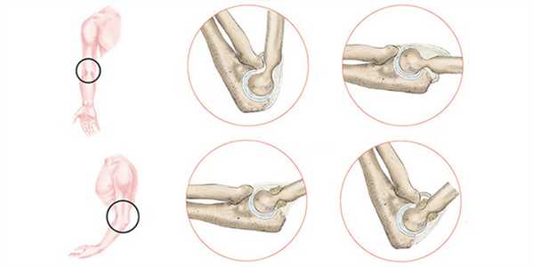 Операции на сухожилиях