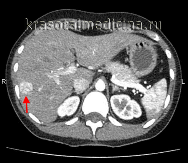 КТ ОБП С+. Гиперваскулярное объемное образование в правой доле печени, соответствующее плотности пула крови во всех фазах – гемангиома