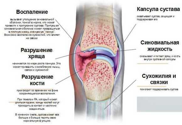 ревматоидный артрит клиническая картина.jpg