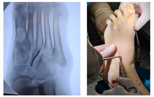 фиксация сухожилия после транспозиции