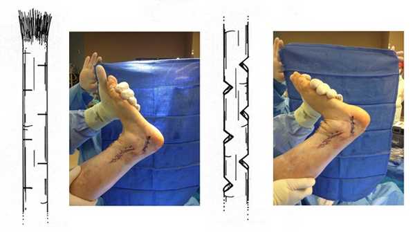 ахиллово сухожилие