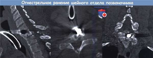 Огнестрельная рана