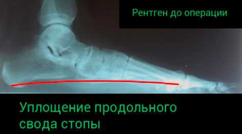 тяжелое плосокстопие