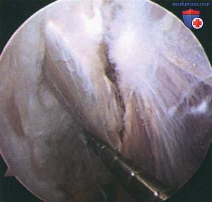 Операция при нейропатии надлопаточного нерва