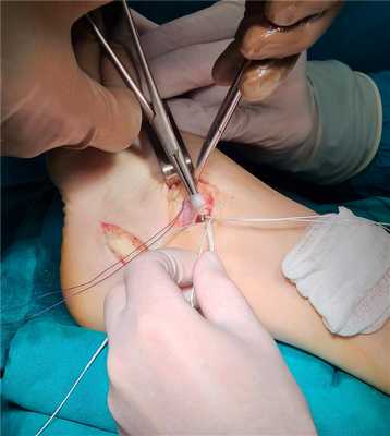 стабилизация голеностопного сустава при помощи синтетического импланта