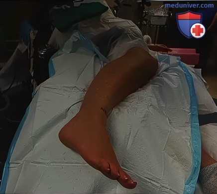 Операция аллопластика при тендинопатии сухожилий малоберцовых мышц