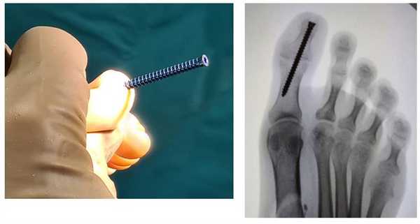 артродез первого межфалангового сустава