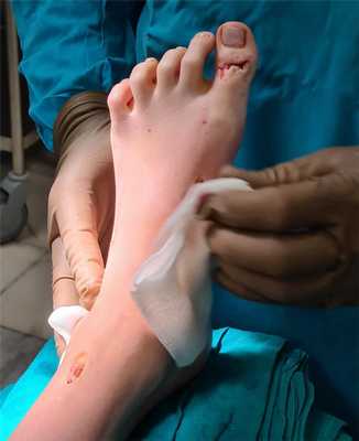 операция при полой стопе результат