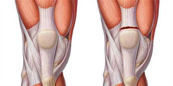 Операции на сухожилиях