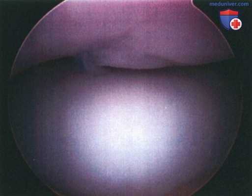 Операция при рассекающем остеохондрите локтевого сустава