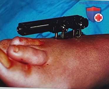 Операция удлинения плюсневых костей стопы