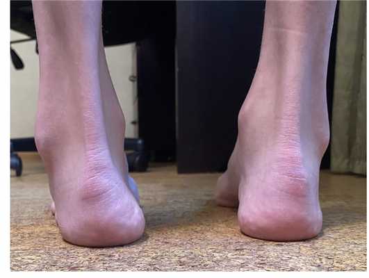 полая стопа половарусная стопа