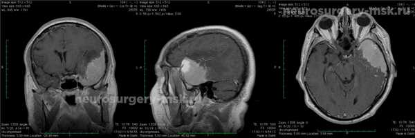 Менингиома средней черепной ямки (до операции)