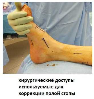 полая стопа операция