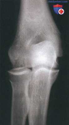 Операция при рассекающем остеохондрите локтевого сустава