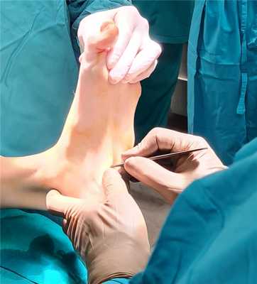 релиз подошвенного апоневроза