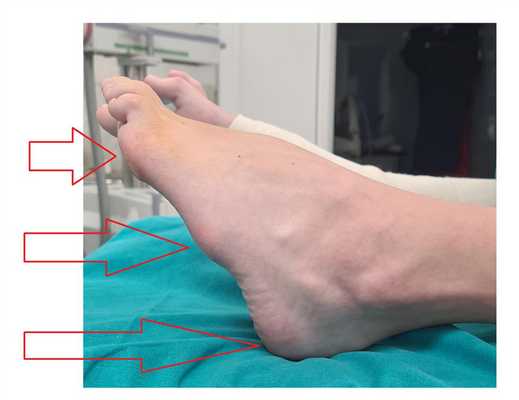 гиперкератозы при полой стопе