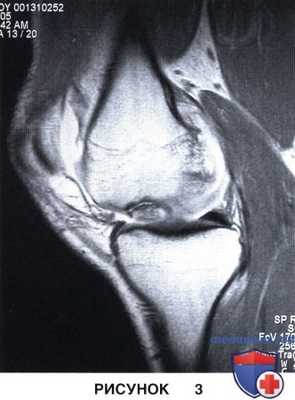 Показания и подготовка к операции при рассекающем остеохондрите коленного сустава