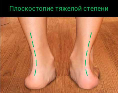 плосокстопие тяжелой степени