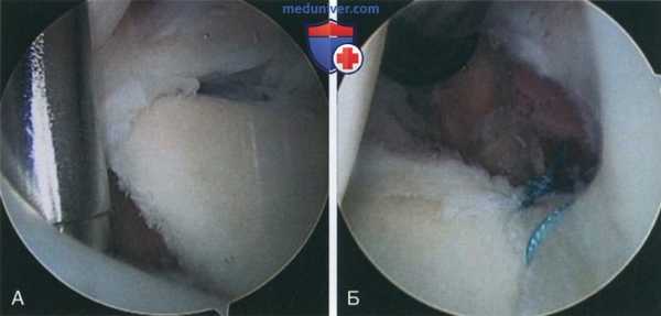 Операция при нейропатии надлопаточного нерва