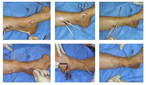 Транспозиция сухожилия задней большеберцовой мышцы