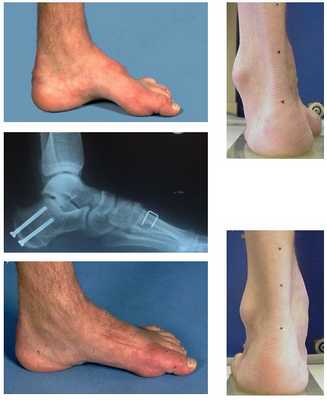 лечение полой стопы