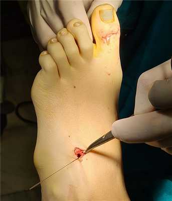 операция при полой стопе транспозиция сухожилия