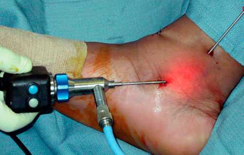 артроскопическая теносиновэктомия