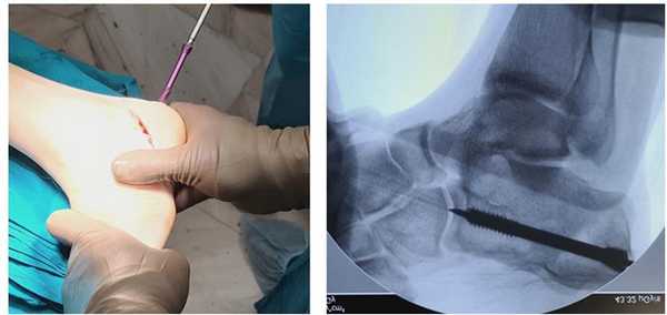фиксация остеотомии пяточной кости при полой стопе