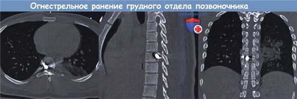 Огнестрельное ранение грудного отдела позвоночника