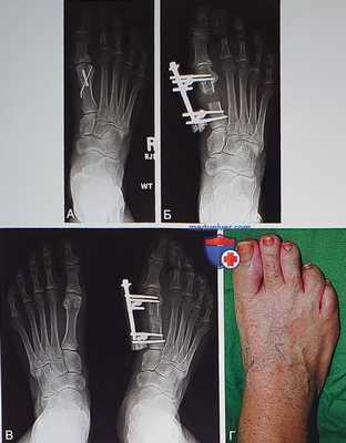 Операция удлинения плюсневых костей стопы