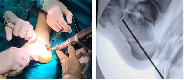 операция при полой стопе остеотомия пяточной кости